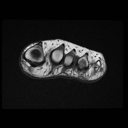 Morton Neuroma Image Radiopaedia Org