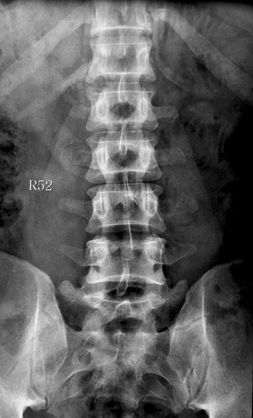 Lumbosacral Transitional Vertebra Type IIb Image Radiopaedia Org