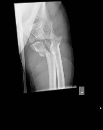 Olecranon Fracture Comminuted Image Radiopaedia Org