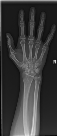 Normal Hand Radiology Case Radiopaedia Org