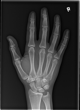 Normal Hand Radiology Case Radiopaedia Org