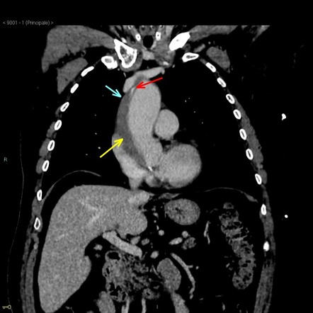 Aortic Intramural Hematoma Ultrasound