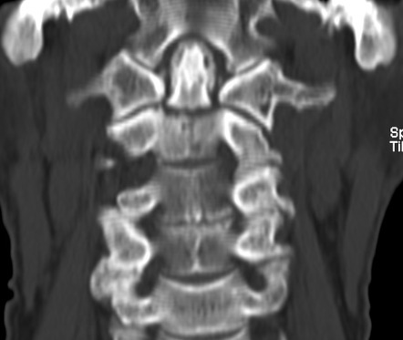 Odontoid Fracture Type II Radiology Case Radiopaedia Org