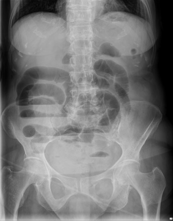 Small Bowel Obstruction And Inguinal Hernia Radiology Case Hot Sex