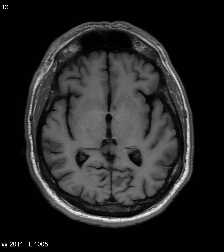 Susac Syndrome Image Radiopaedia Org