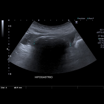 Gallstone Ileus Image Radiopaedia Org