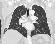 Intercostal Lung Hernia Radiology Reference Article Radiopaedia Org