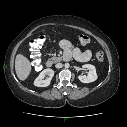 Abdominal Hernia Radiology Reference Article Radiopaedia Org