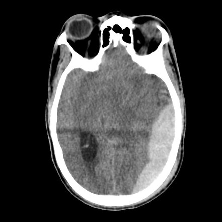 Large Extradural Hematoma Complicated By Duret Hemorrhage And Ischemic