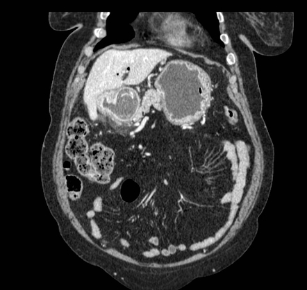 Cholecystoduodenal Fistula Image Radiopaedia Org