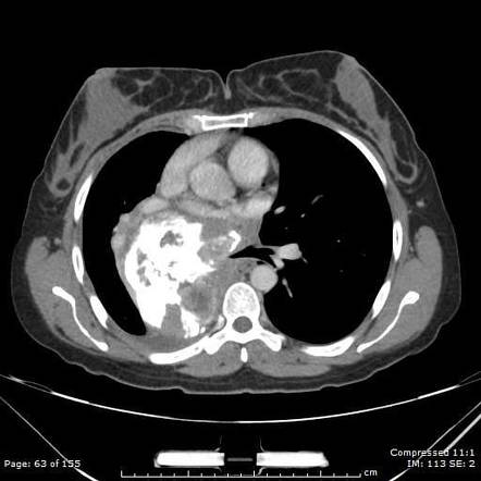 Pleural Tumors Radiology Reference Article Radiopaedia Org