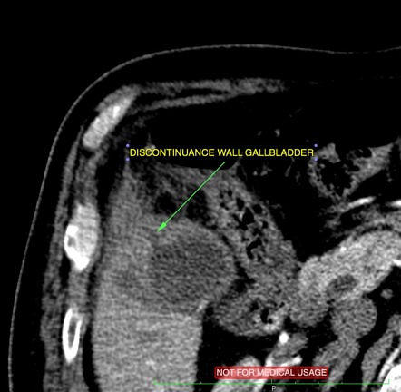 Hepatic Abscess Related To Acute Cholecystitis Image Radiopaedia Org