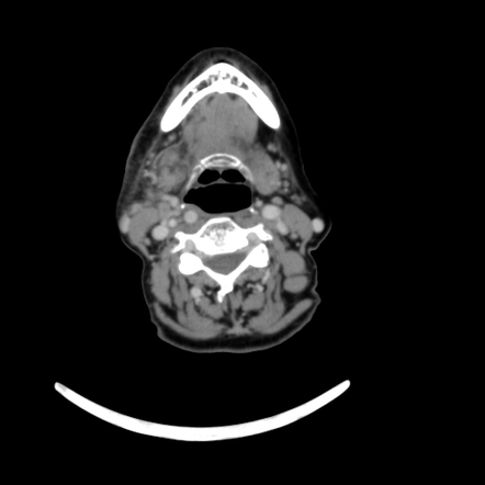 Submandibular Sialolithiasis And Chronic Sialadenitis Image