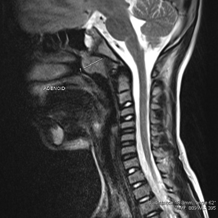 Adenoid Hypertrophy On MRI Image Radiopaedia Org