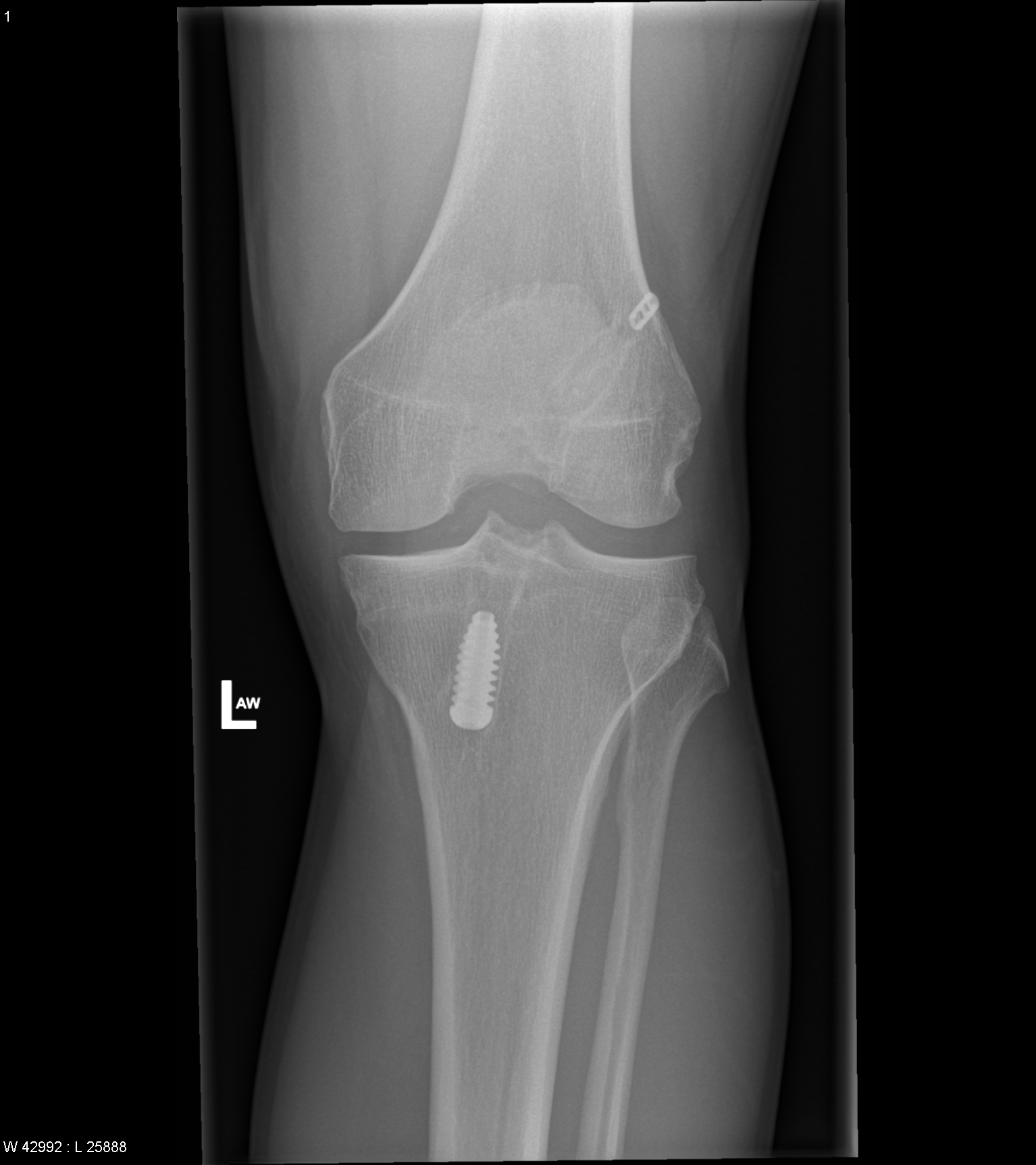 Normal Post ACL Reconstruction Knee Radiograph Image Radiopaedia Org