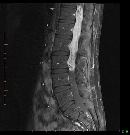 Spinal Schwannoma Radiology Reference Article Radiopaedia Org