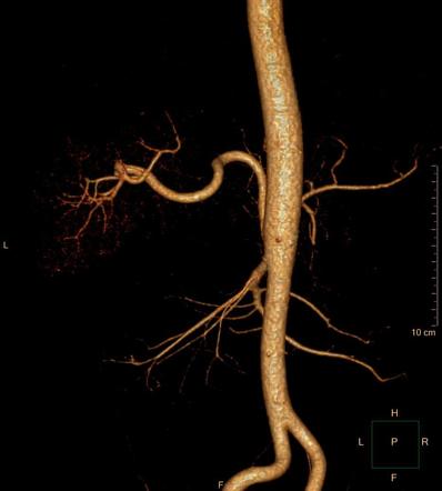 Small Bowel Vascular Angiodysplasia Image Radiopaedia Org