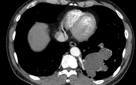 Pulmonary Sequestration Intralobar Radiology Case Radiopaedia Org