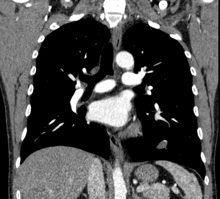 Pulmonary Sequestration Intralobar Image Radiopaedia Org