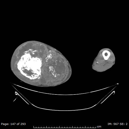 Osteosarcoma With Calcified Metastasis Image Radiopaedia Org