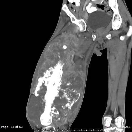 Osteosarcoma With Calcified Metastasis Radiology Case Radiopaedia Org