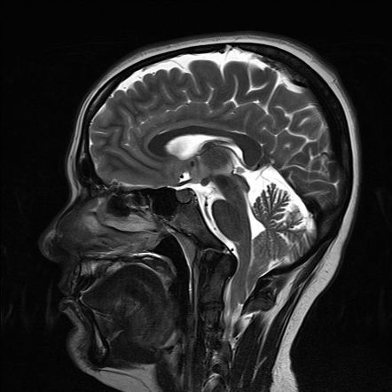 Chiari Malformation Radiology Reference Article Radiopaedia Org