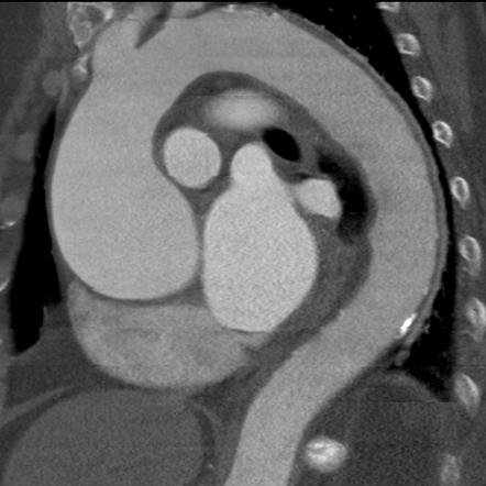 Ascending Aortic Aneurysm Radiology Case Radiopaedia Org