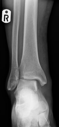 Distal Tibial And Fibular Fractures Radiology Case Radiopaedia Org