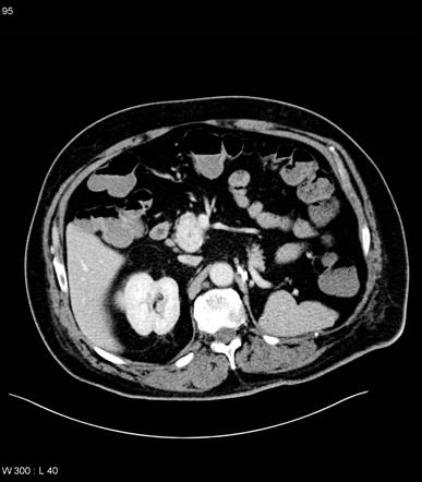 Pancreatic Metastasis From Renal Cell Carcinoma Image Radiopaedia Org