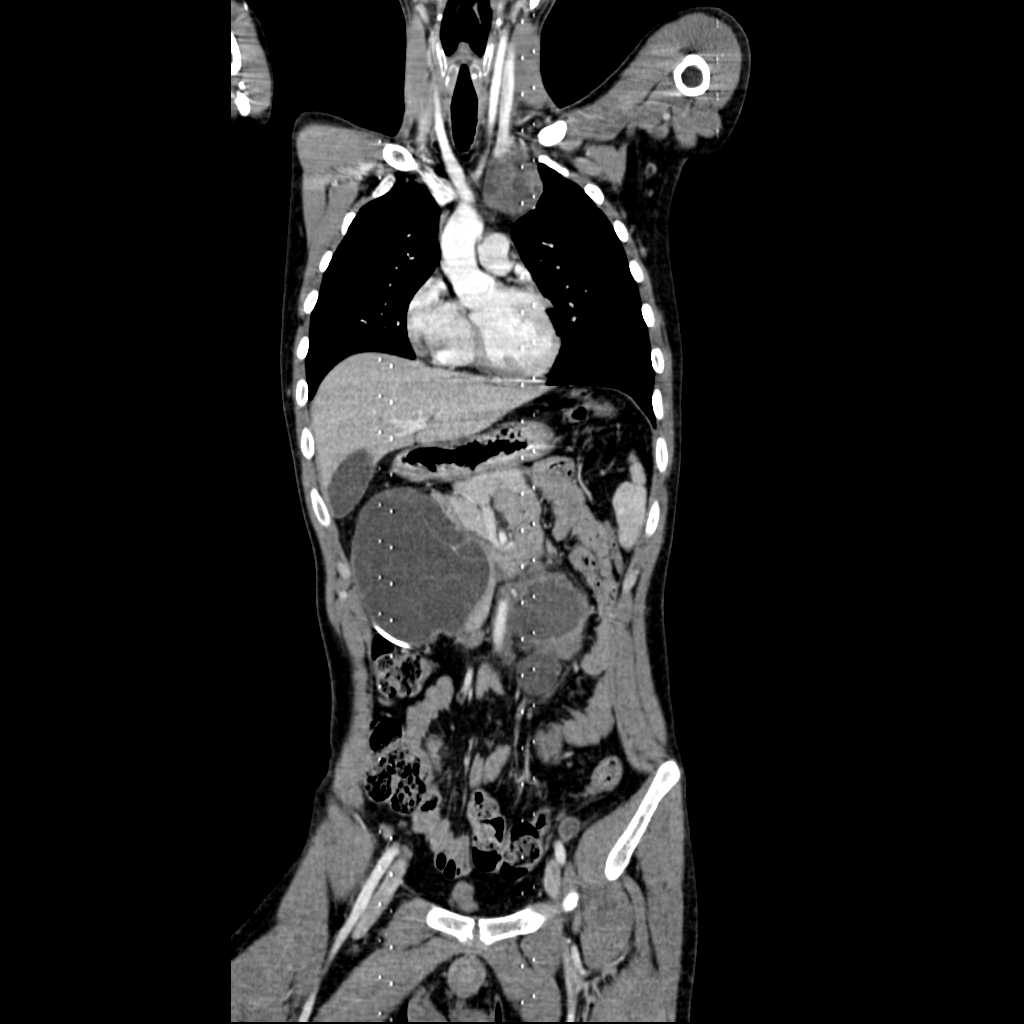 Metastatic Germ Cell Tumor Involving The Mediastinum And