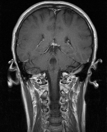 Viewing Playlist Neuroradiology Playlist 2 Radiopaedia Org