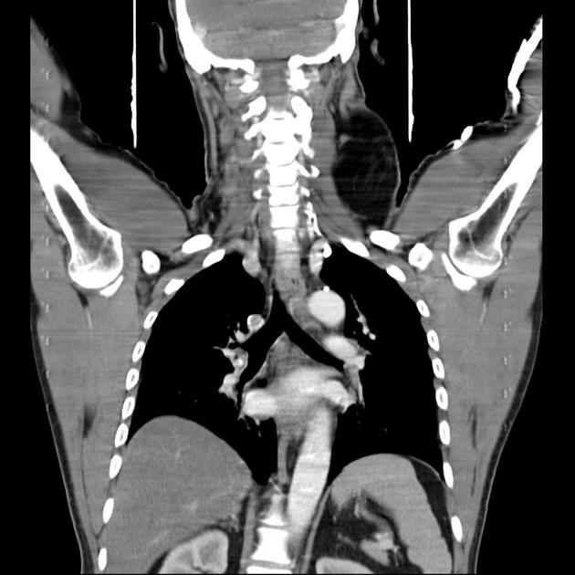 Lipoma Radiology Reference Article Radiopaedia Org