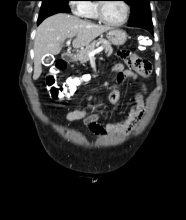 Porcelain Gallbladder Radiology Reference Article Radiopaedia Org