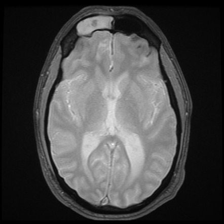 Frontoethmoidal Encephalocele Image Radiopaedia Org