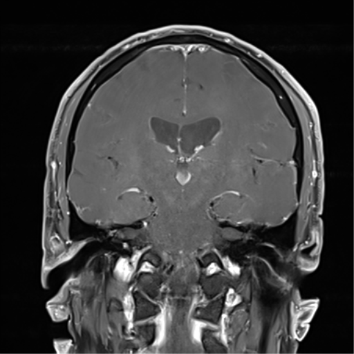 Frontoethmoidal Encephalocele Image Radiopaedia Org