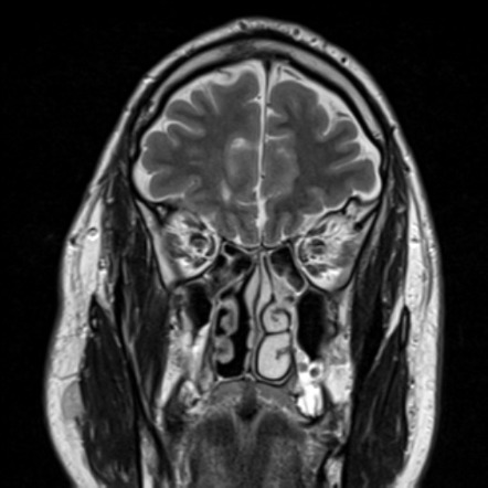 Frontoethmoidal Encephalocele Image Radiopaedia Org