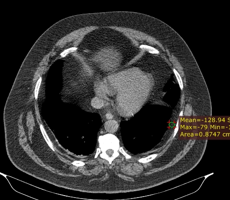 Extrapleural Lipomatosis Image Radiopaedia Org