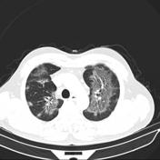 Ground Glass Opacification Radiology Reference Article Radiopaedia Org