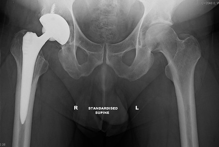 Aseptic Loosening Of Right Hip Implant Radiology Case Radiopaedia Org