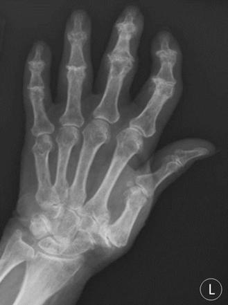 Erosive Osteoarthritis Radiology Reference Article Radiopaedia Org