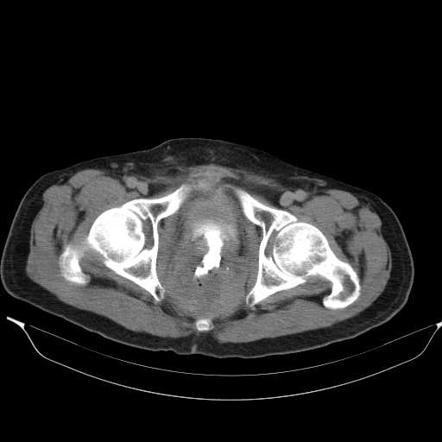 Colovesical Fistula Radiology Reference Article Radiopaedia Org