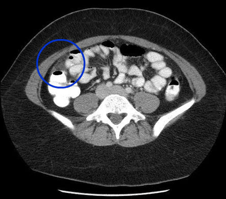 Fitz Hugh Curtis Syndrome Image Radiopaedia Org