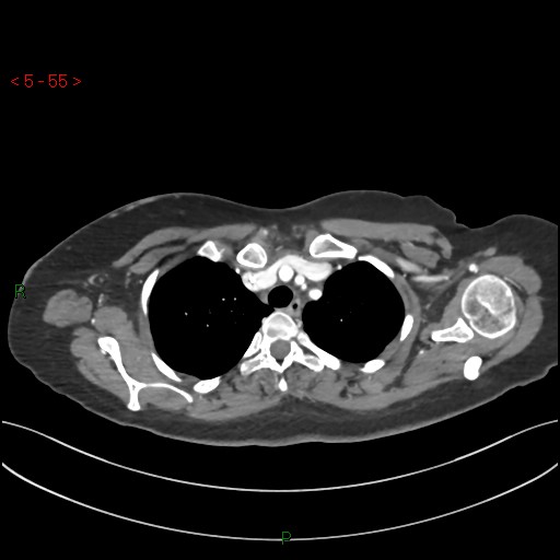 Aortic Arch Origin Of Left Vertebral Artery Image Radiopaedia Org