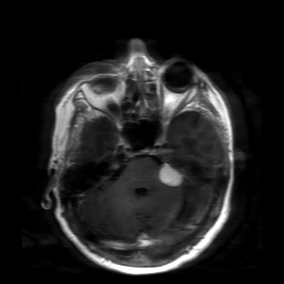 Meningioma Radiopaedia Hot Sex Picture