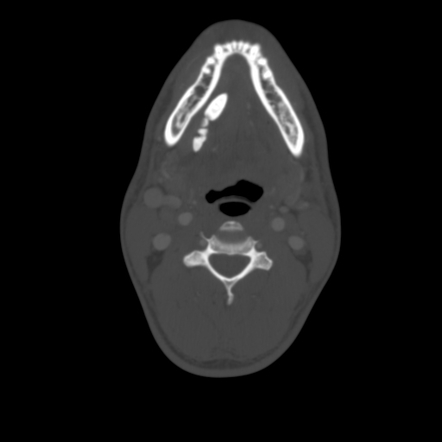 Sialadenitis Secondary To Sialolithiasis Image Radiopaedia Org