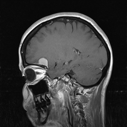 Meningioma Radiology Case Radiopaedia Org