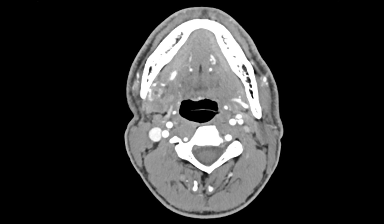 Sialolithiasis Image Radiopaedia Org