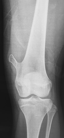 Osteochondroma Radiology Case Radiopaedia Org