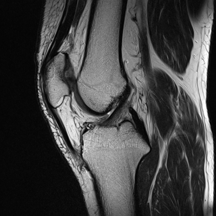 Chondromalacia Patellae Image Radiopaedia Org