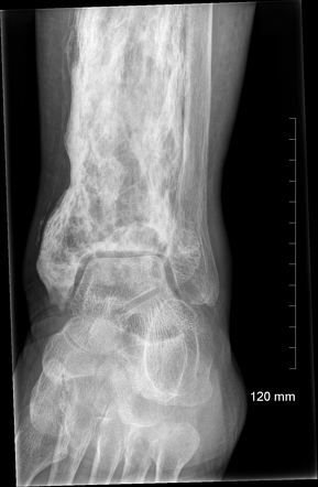 Paget Disease Radiology Case Radiopaedia Org